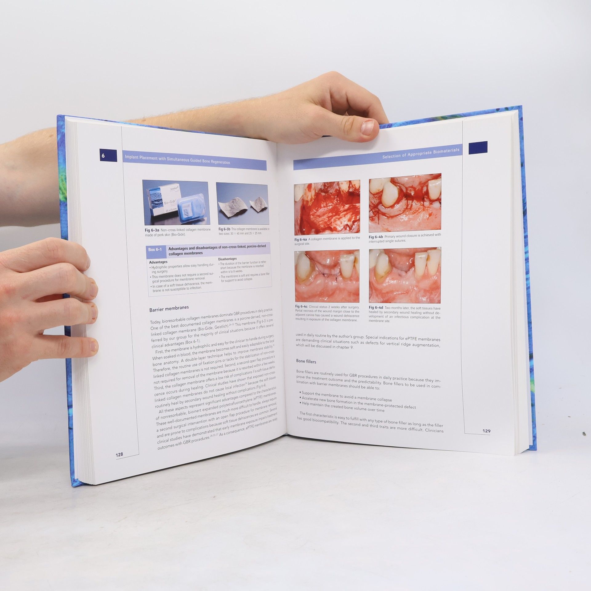Daniel Buser 20 Years of Guided Bone Regeneration in Implant Dentistry