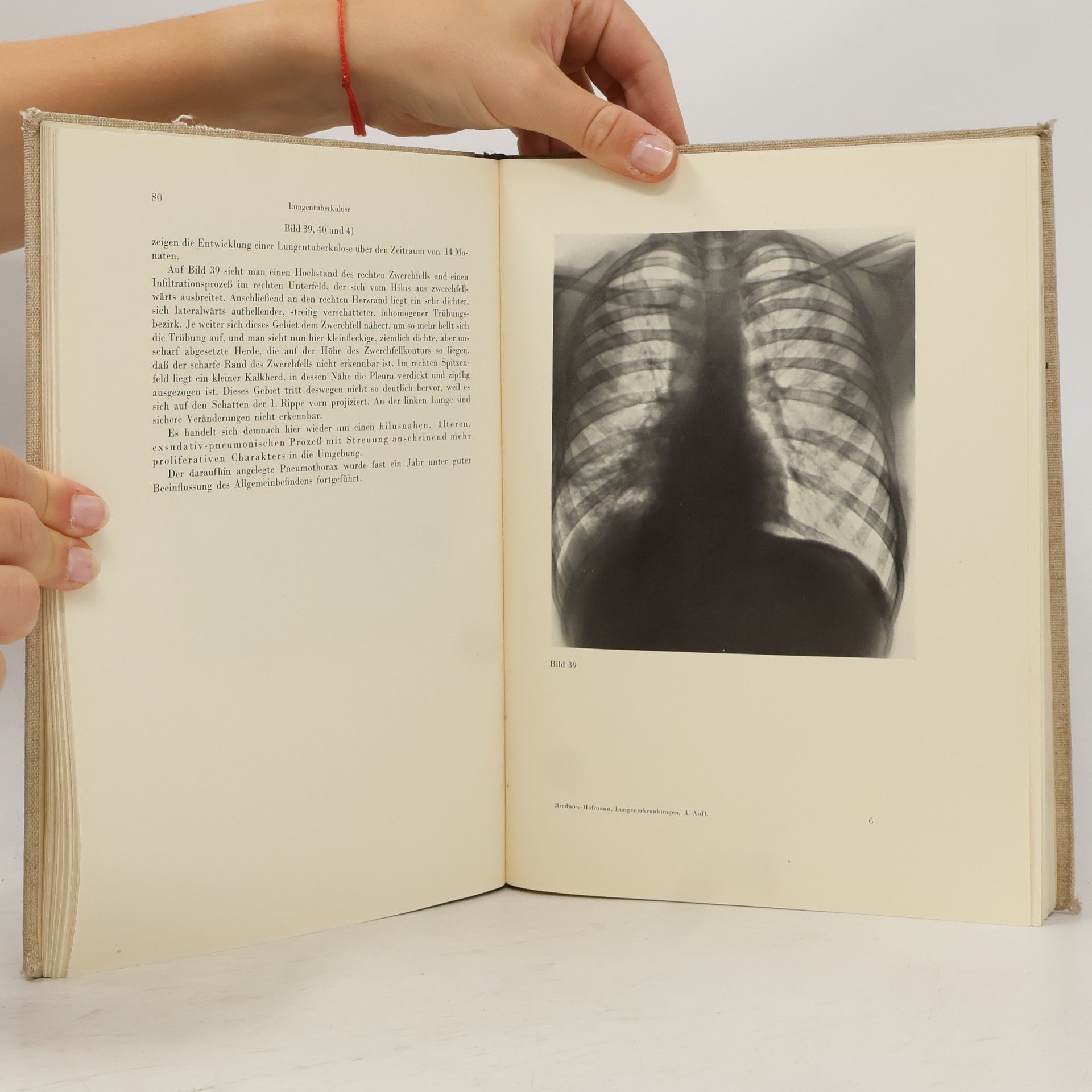 Erich Hofmann Rontgenatlas der Lungenerkrankungen