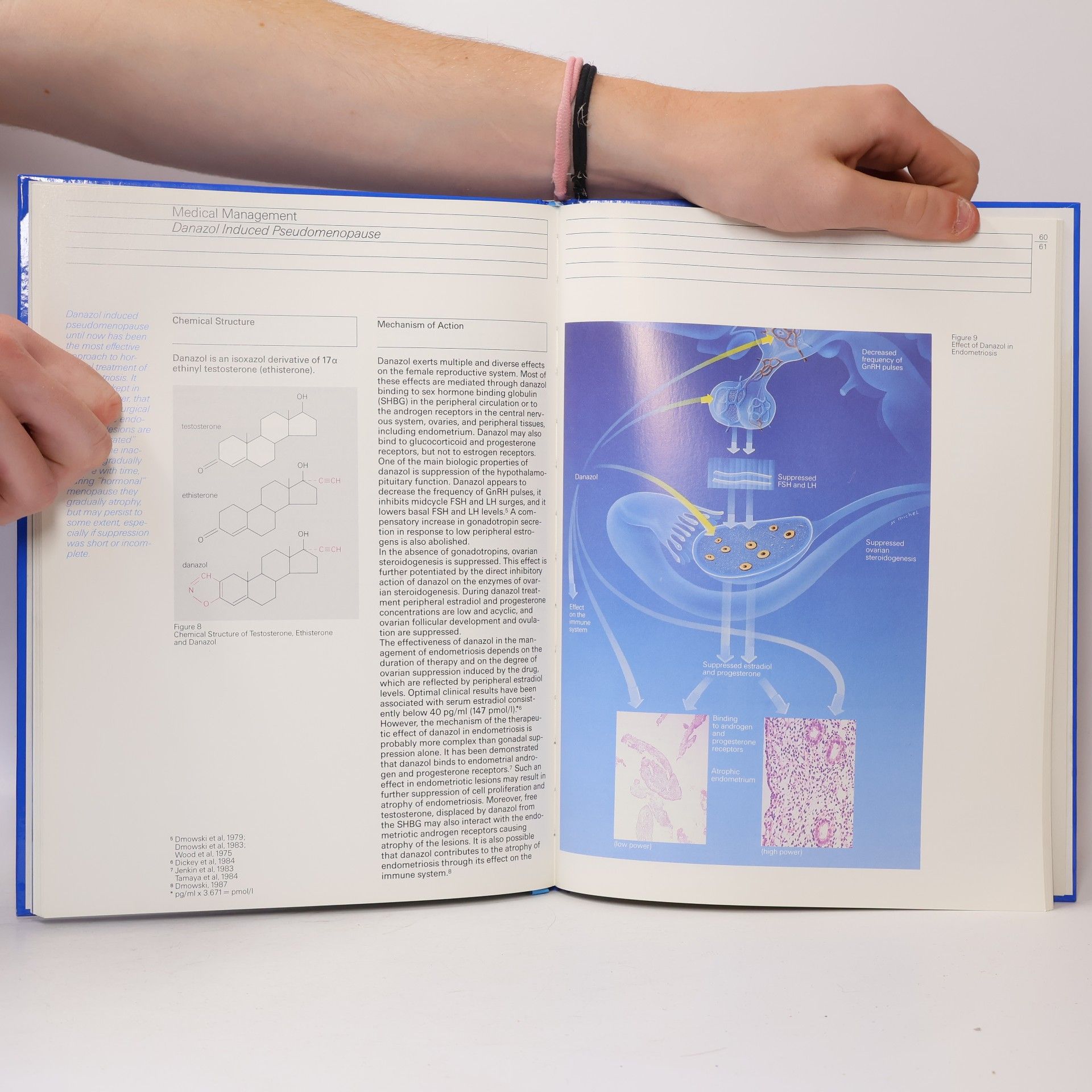 K. W. Schweppe Endometriosis