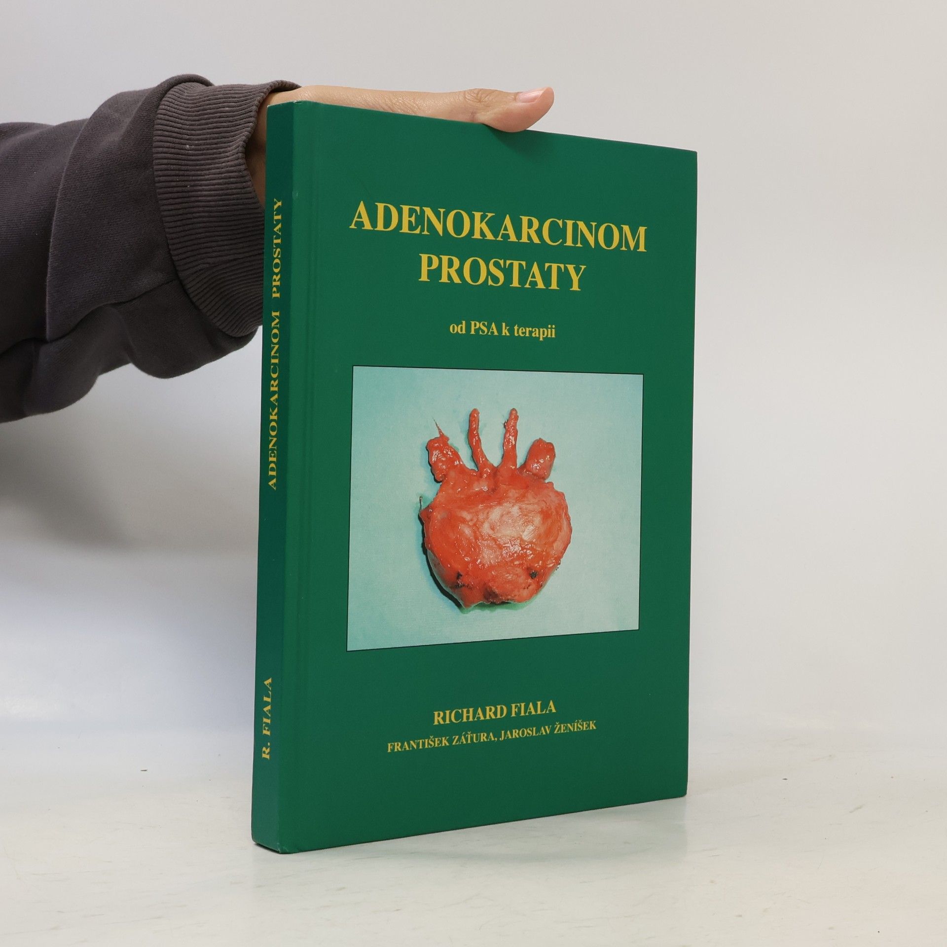 Jaroslav Ženíšek Adenokarcinom prostaty od PSA k terapii