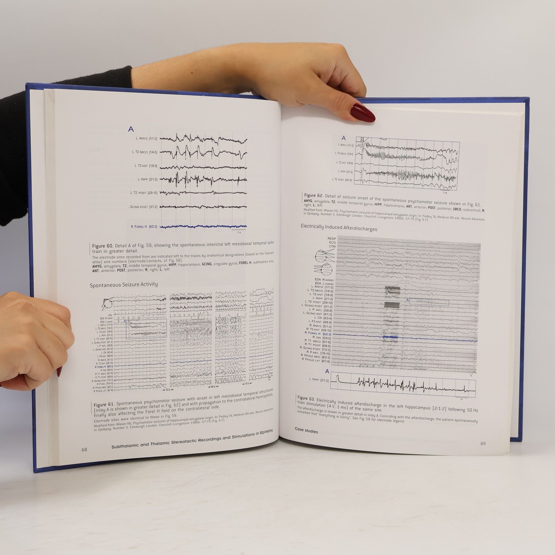 Heinz Gregor Wieser Subthalamic and Thalamic Stereotactic Recordings and Stimulations in Patients with Intractable Epilepsy