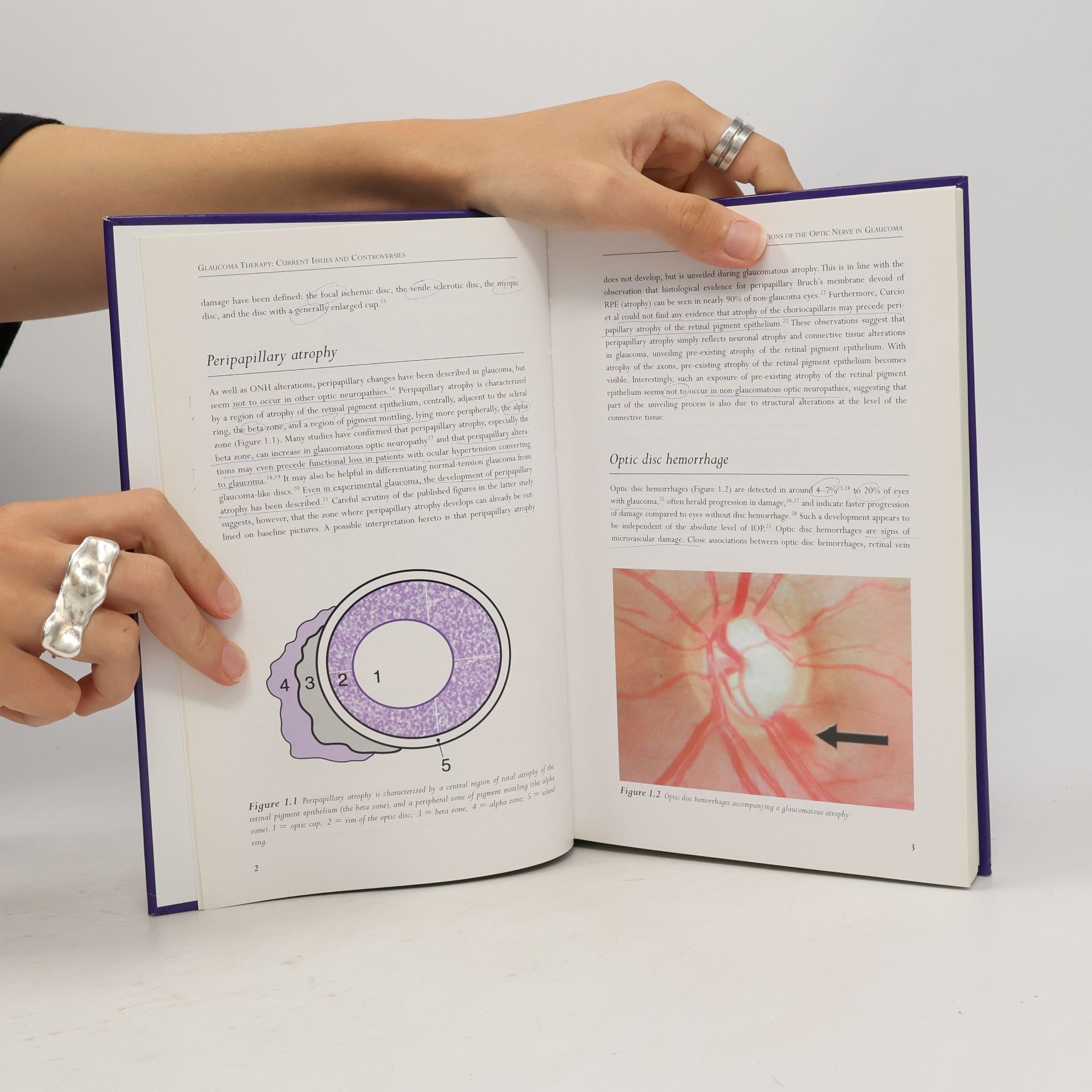Tarek M. Shaarawy Glaucoma Therapy