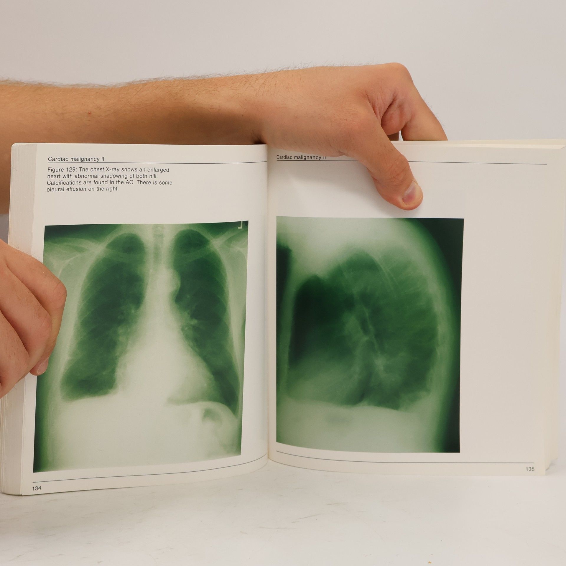 J. P. M. Hamer Biplane Transesophageal Echocardiography