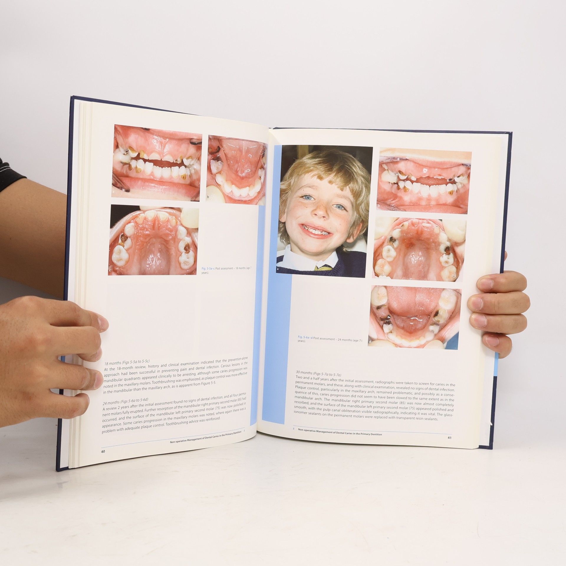 Evert van Amerongen Case Reports in Pediatric Dentistry
