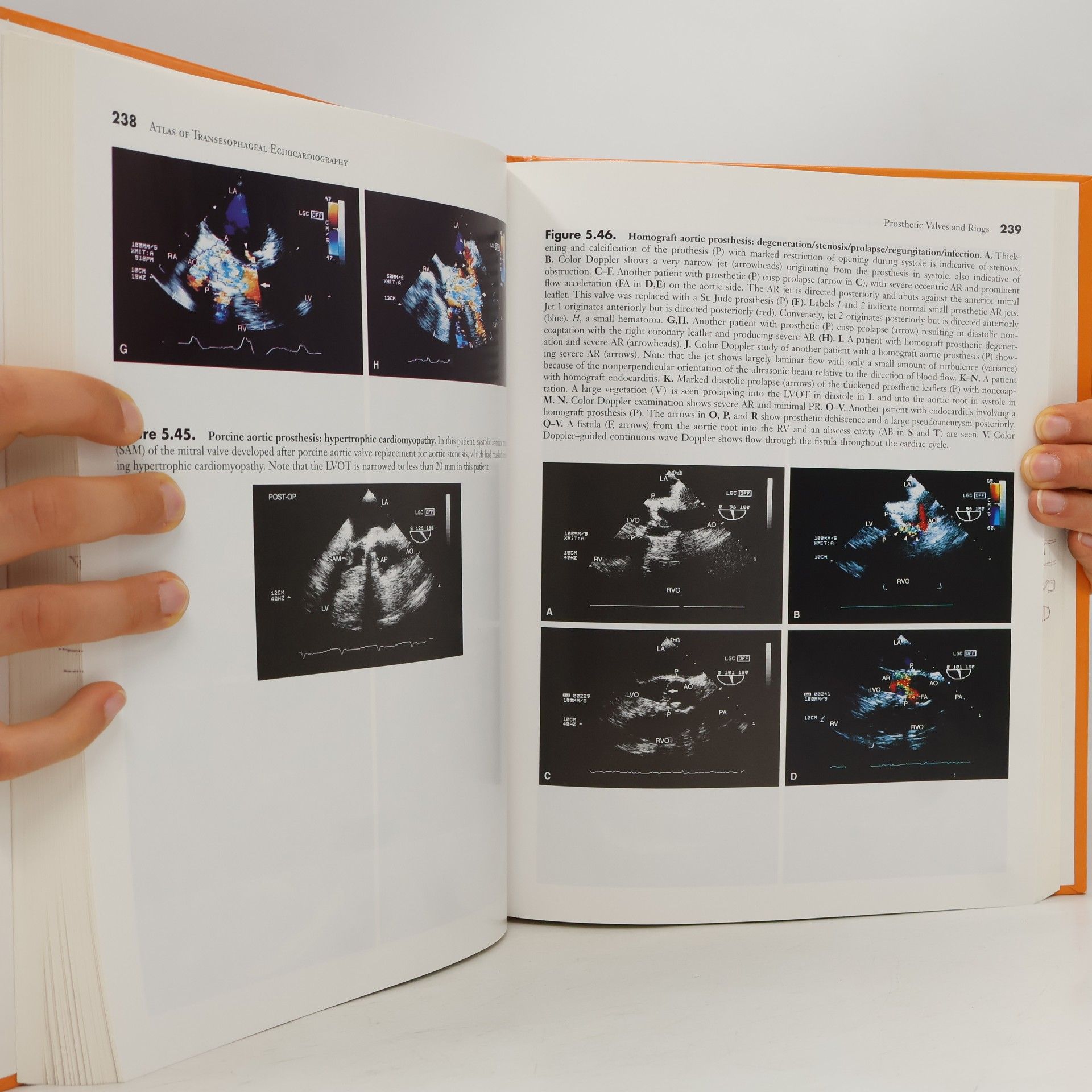 navin-c-nanda-michael-j-domanski Atlas of Transesophageal Echocardiography
