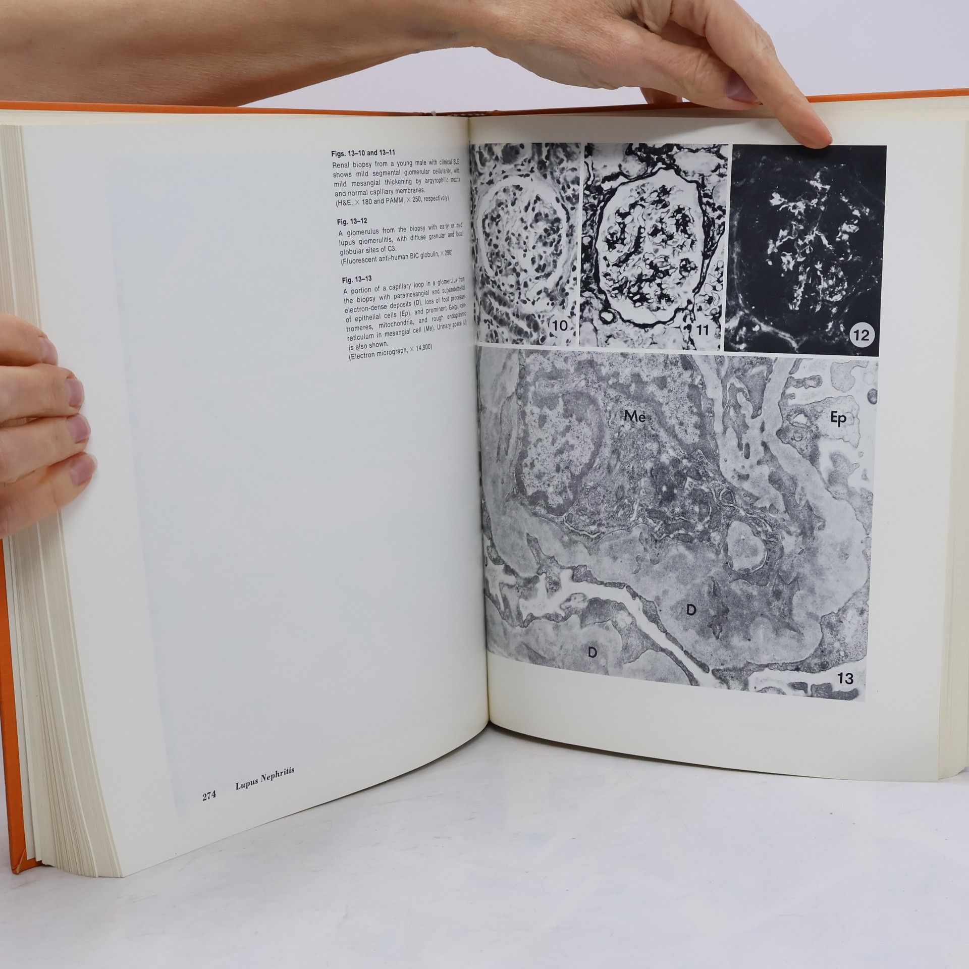 Peter M. Burkholder Atlas of Human Glomerular Pathology