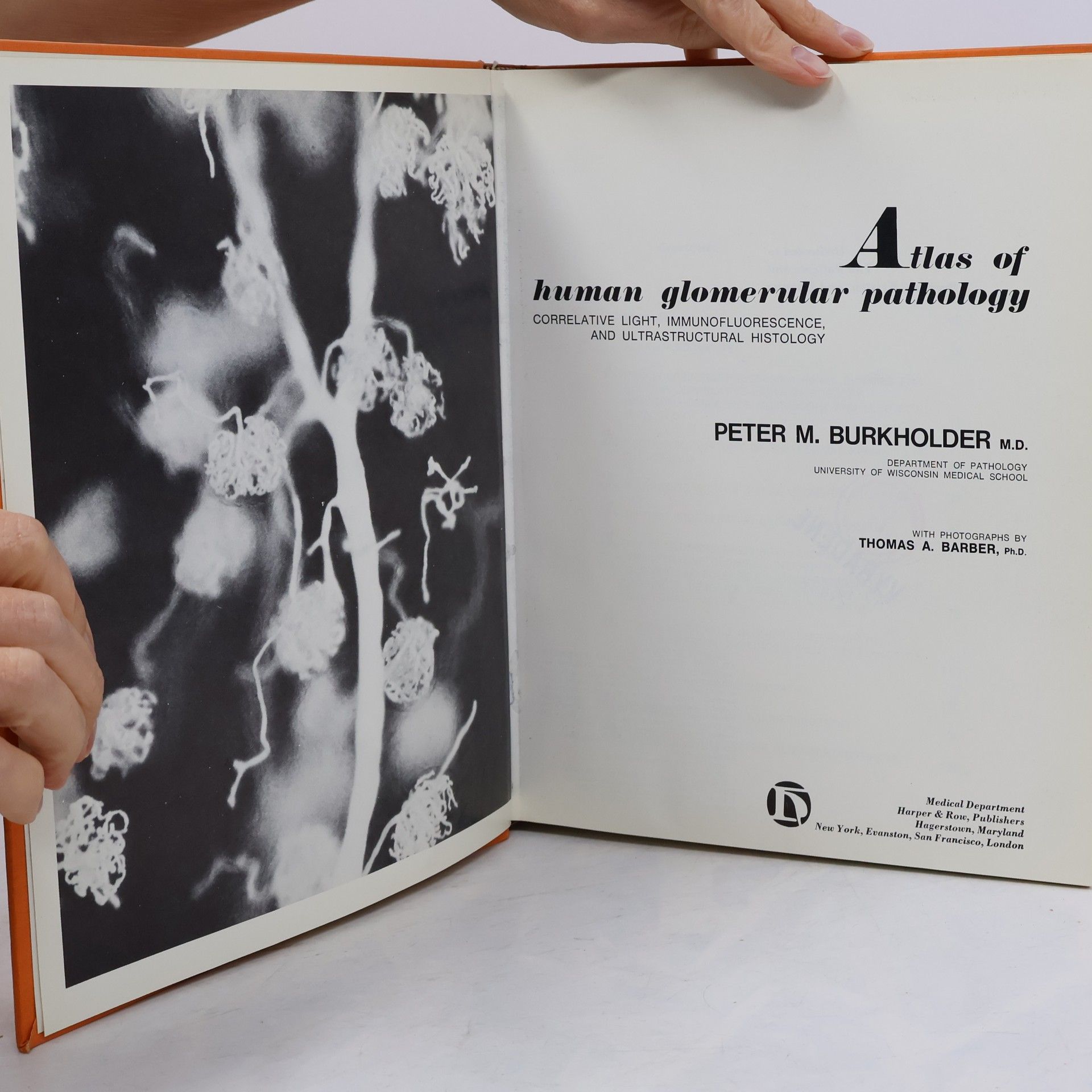 Peter M. Burkholder Atlas of Human Glomerular Pathology