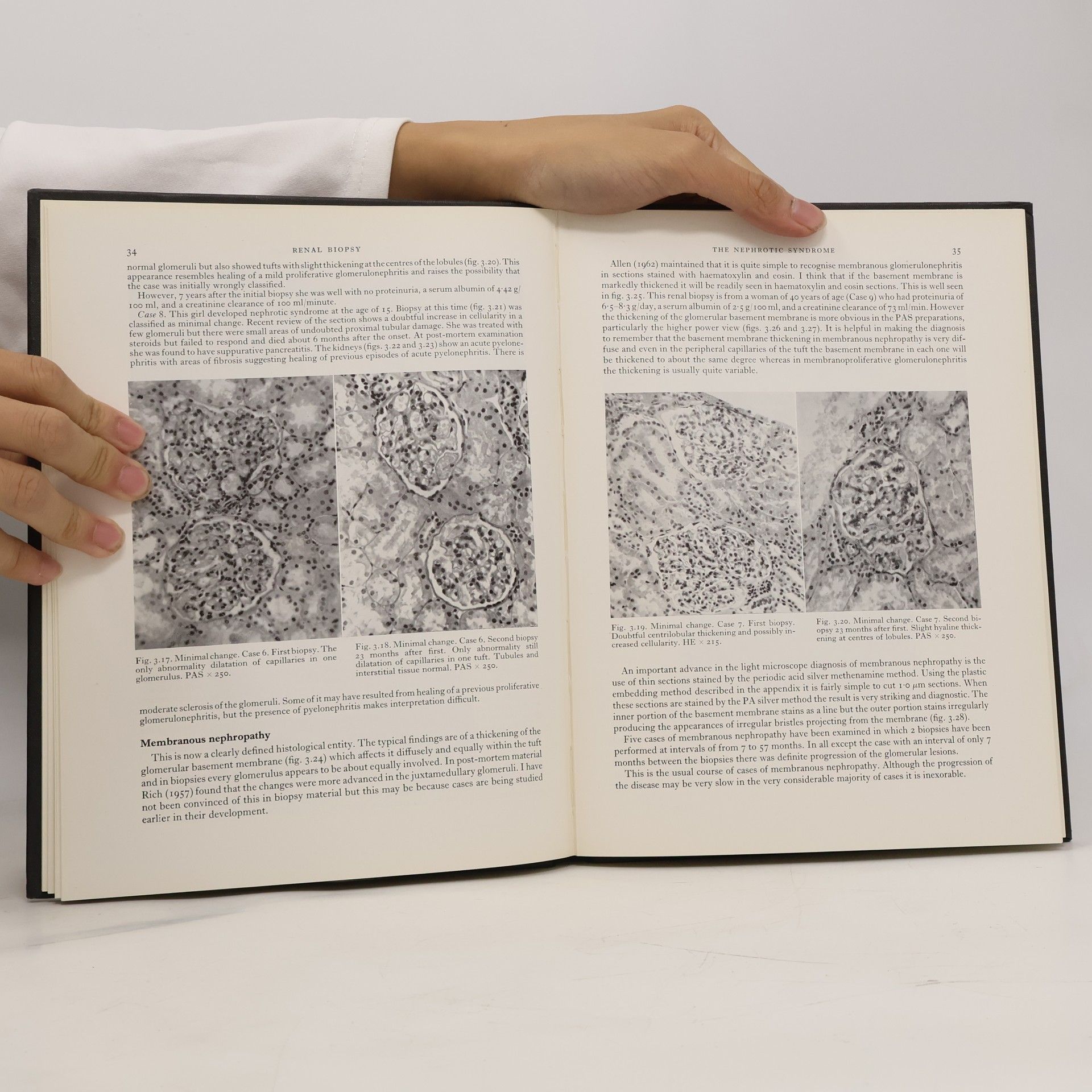 Douglas Bertram Brewer Renal biopsy