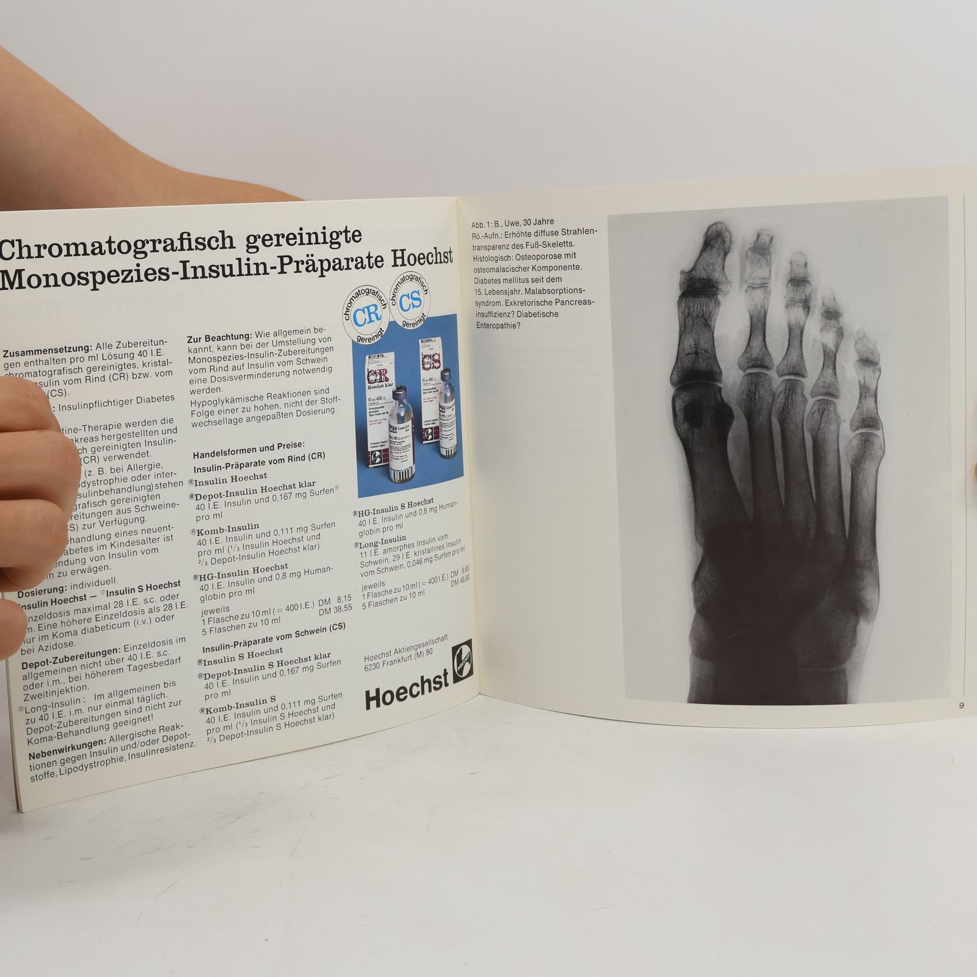 Autorenkollektiv Diabetes im Bild 13. Die diabetischen Osteopathien