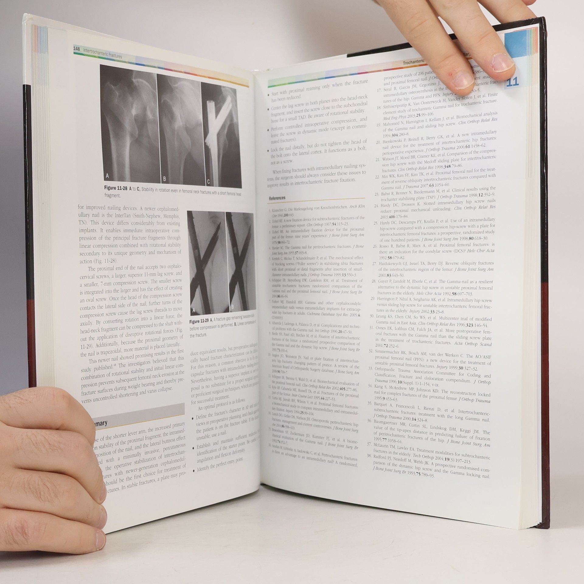 James P. Waddell Fractures Of The Proximal Femur