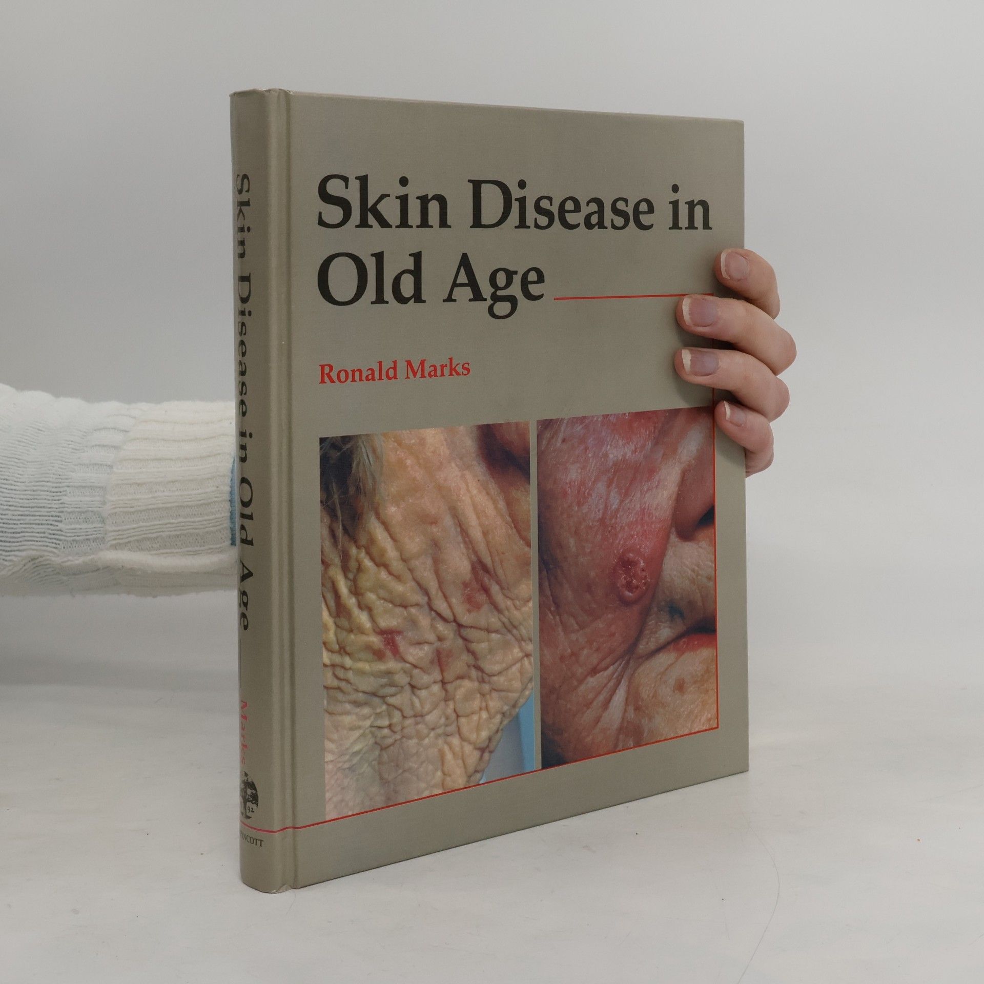 Ronald Marks Skin Disease in Old Age