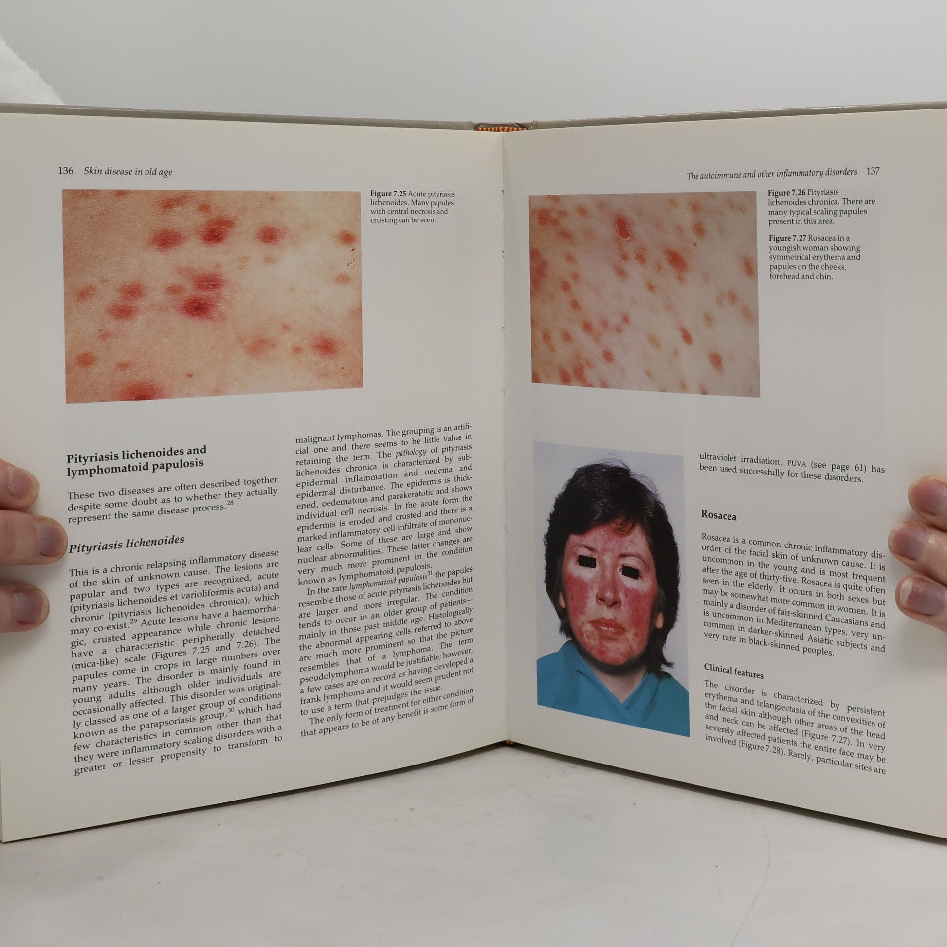 Ronald Marks Skin Disease in Old Age