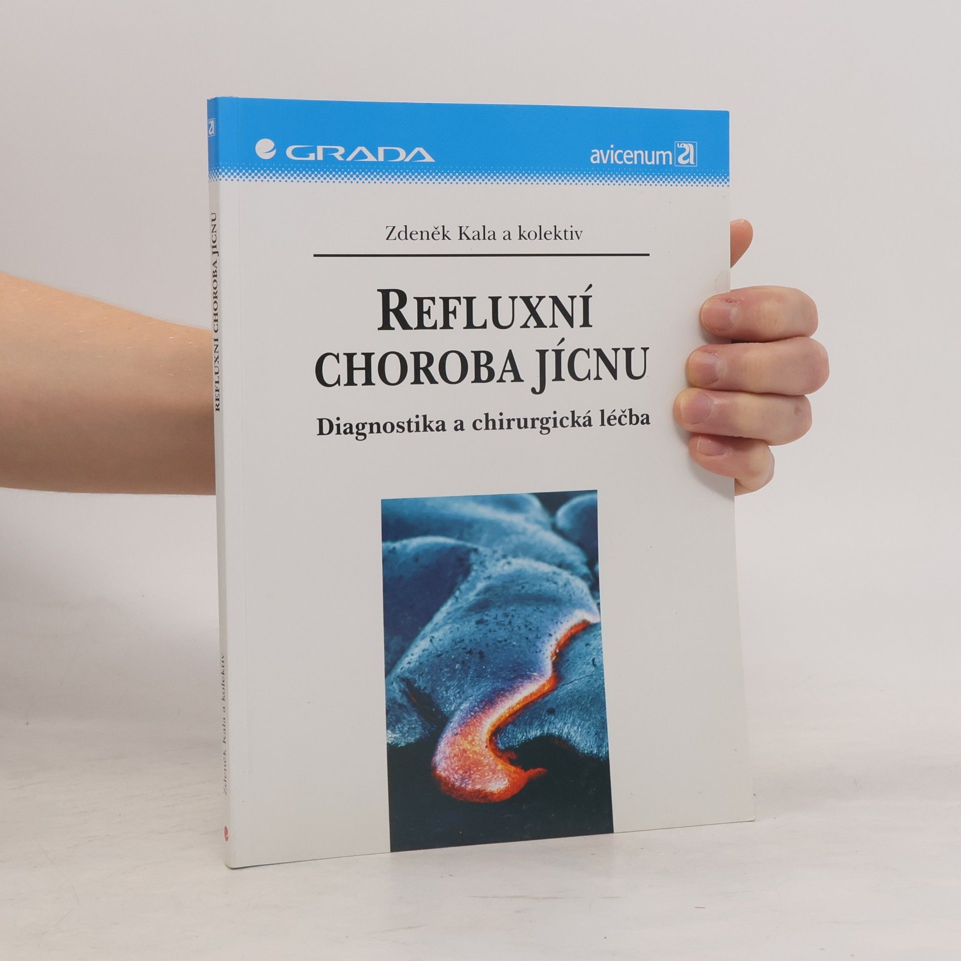 Refluxní choroba jícnu : diagnostika a chirurgická léčba