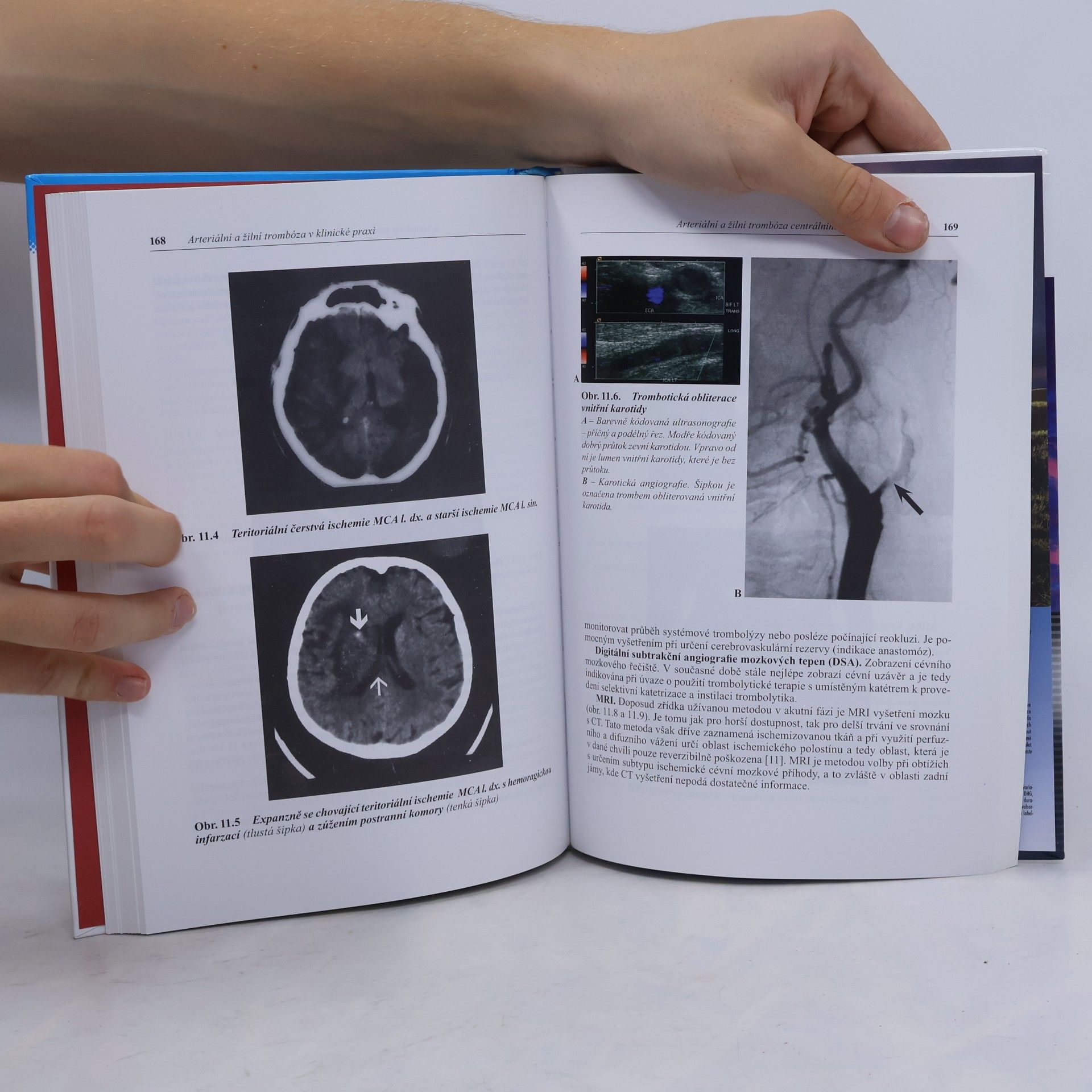 Jan František Vojáček Arteriální a žilní trombóza v klinické praxi