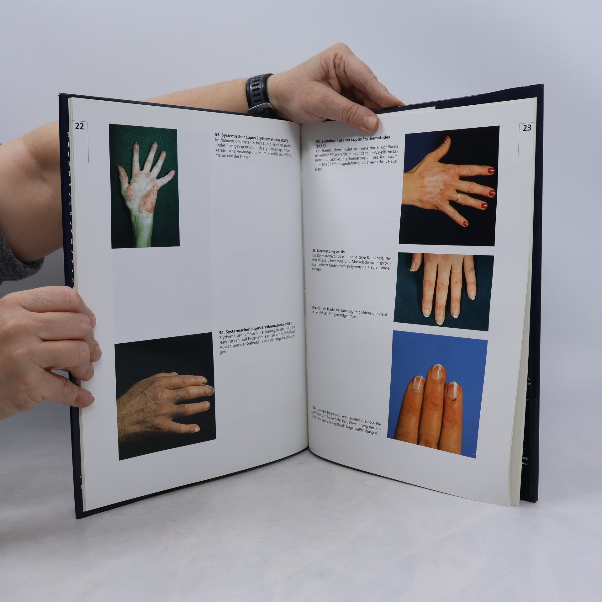 Bildatlas zu Veränderungen der Hand bei rheumatischen Erkrankungen und deren Grenzgebieten