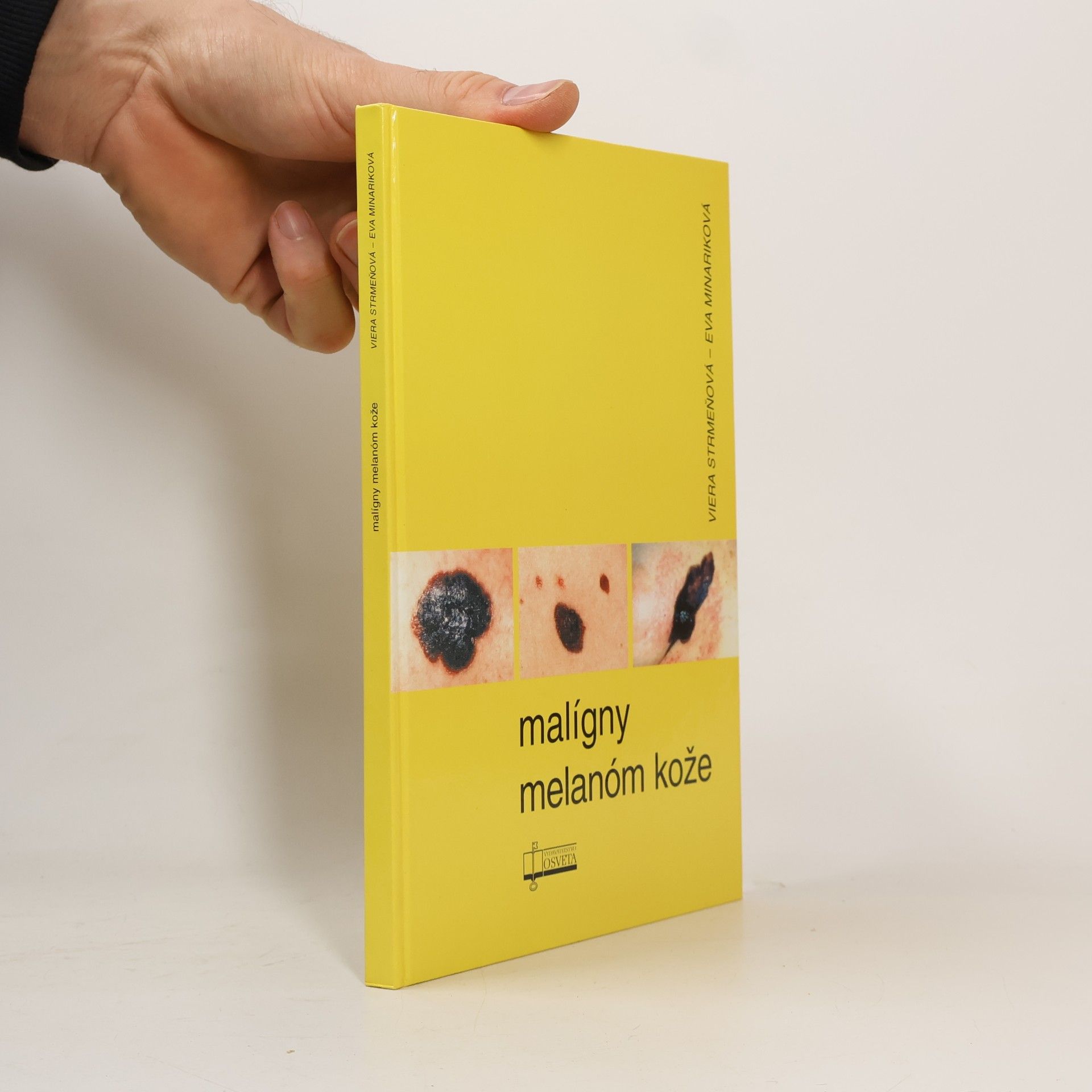 Viera Strmen̆ová́ Malígny melanóm kože