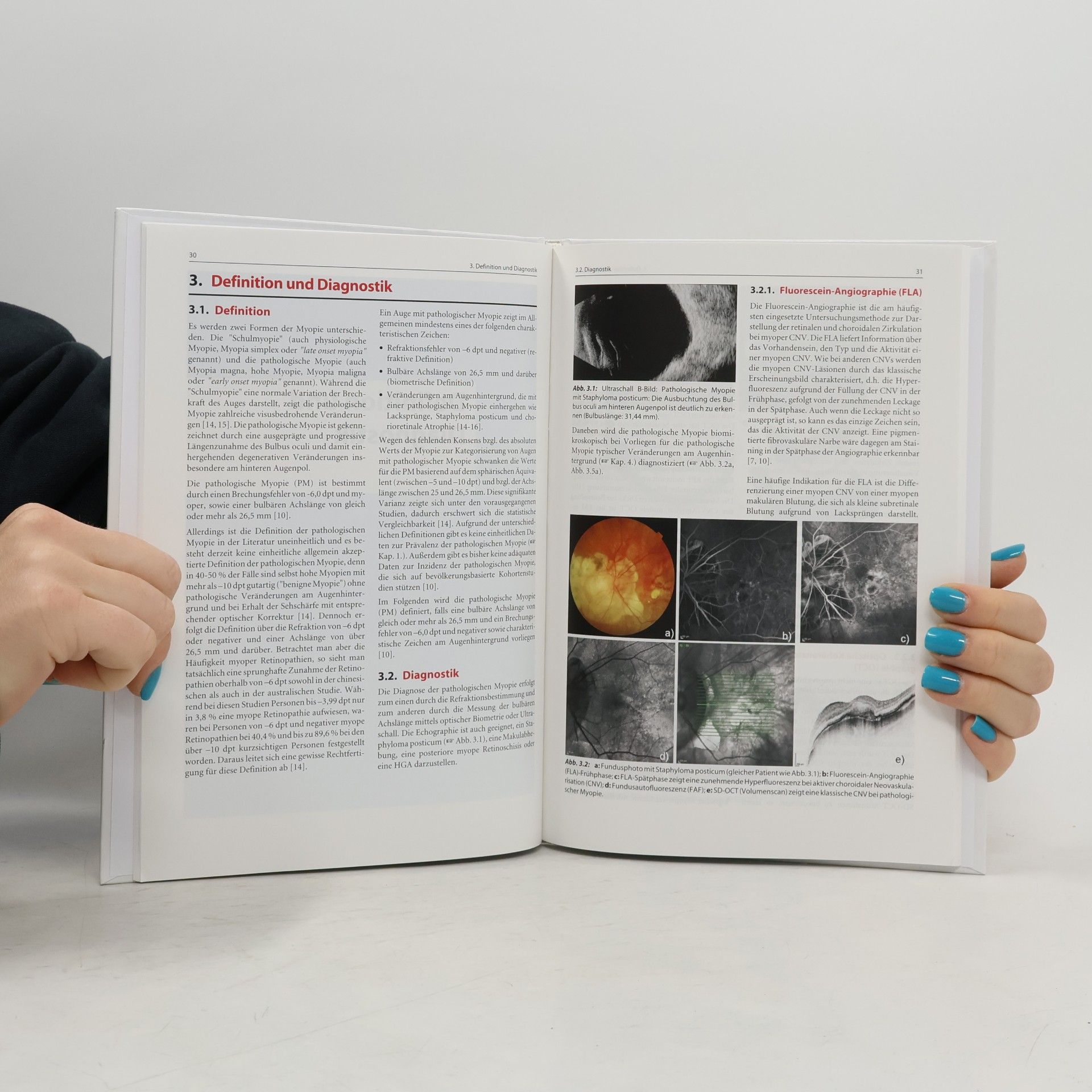 Mathias Maier-Borst Diagnose und Therapie der pathologischen Myopie - 2. Auflage