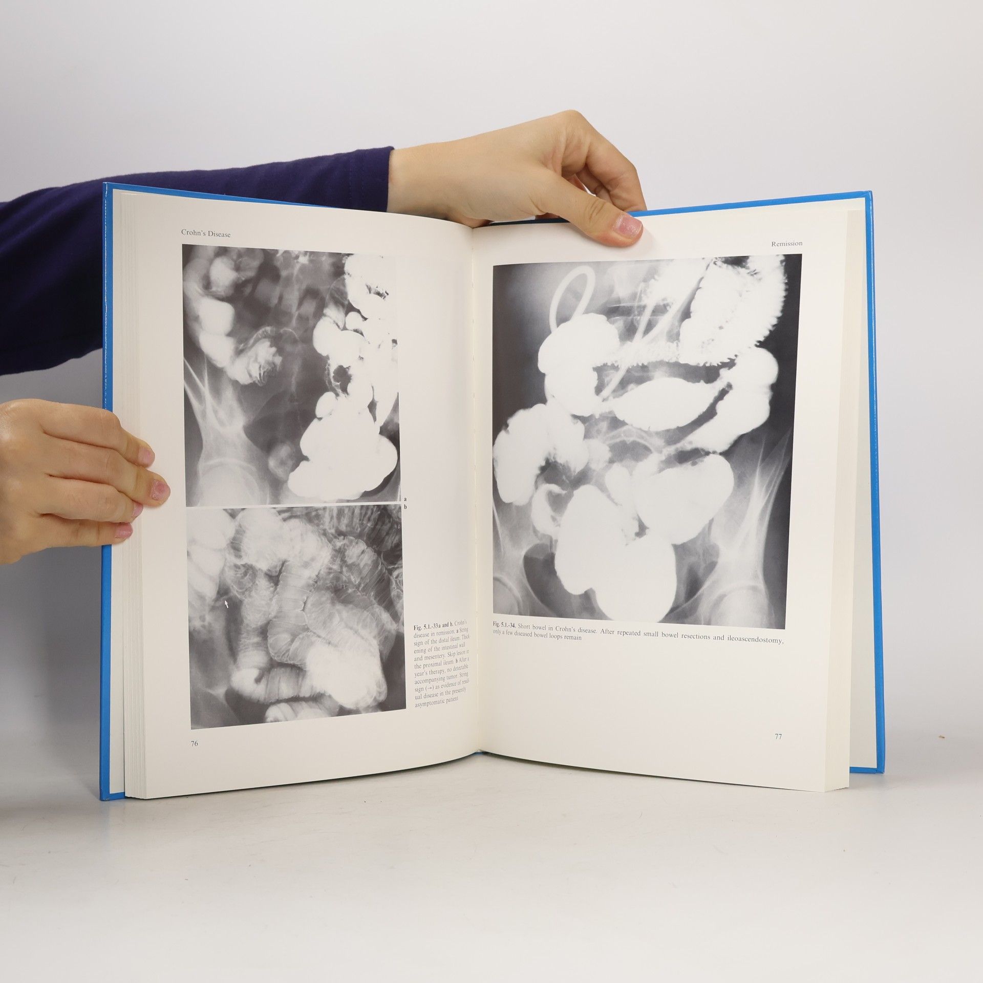 Günther Antesberger Small Bowel Radiology