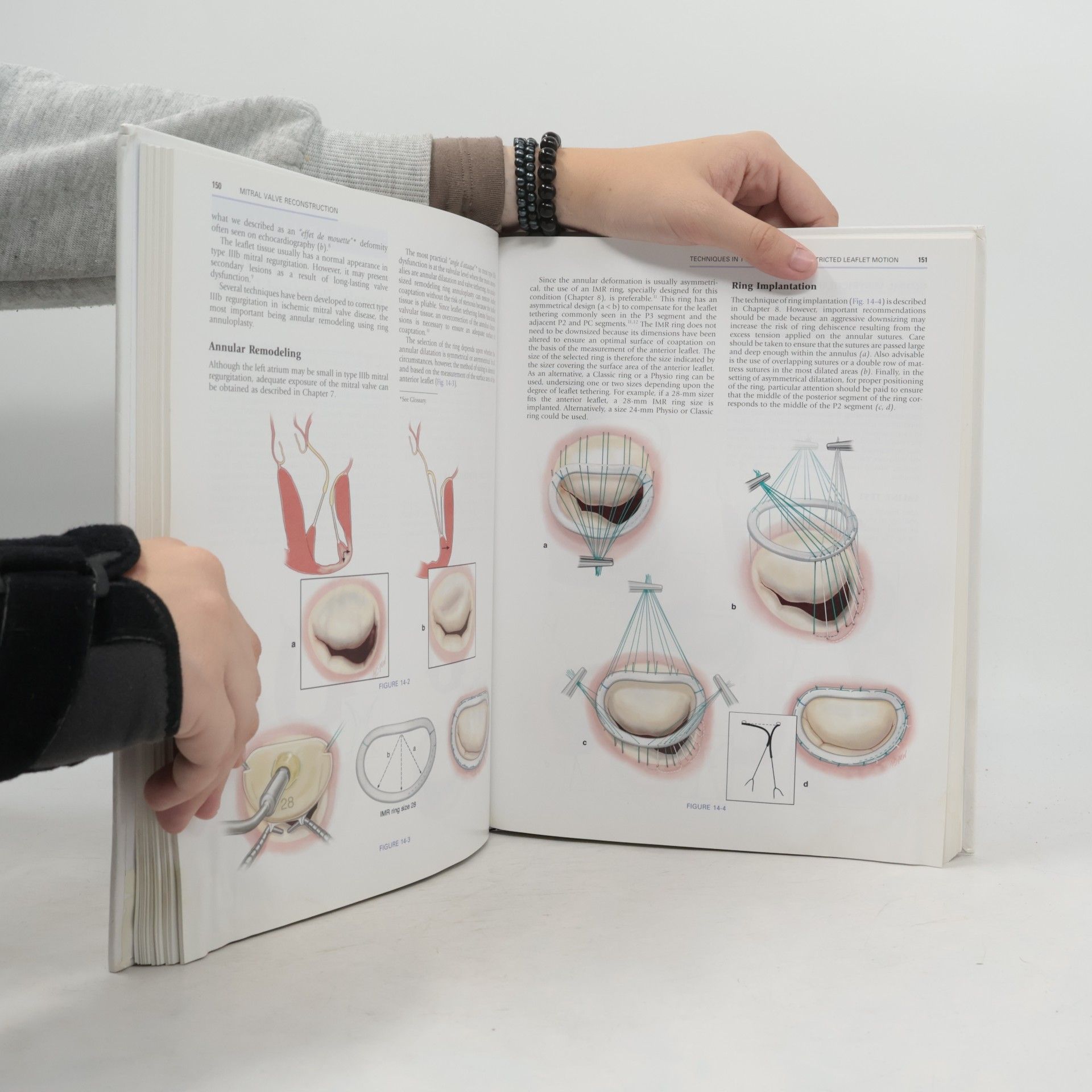Alain Carpentier Carpentier's Reconstructive Valve Surgery