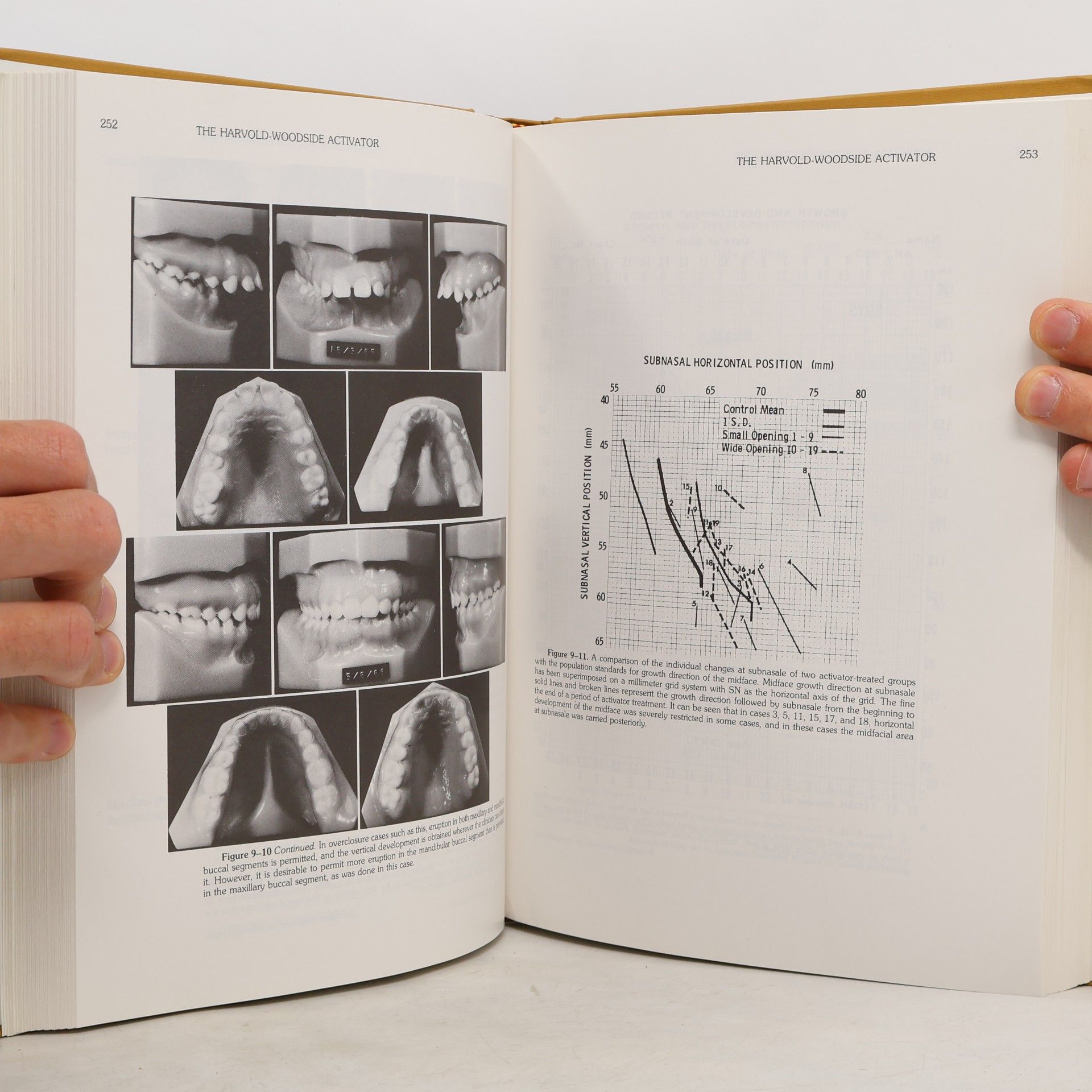 Thomas M. Graber Removable Orthodontic Appliances