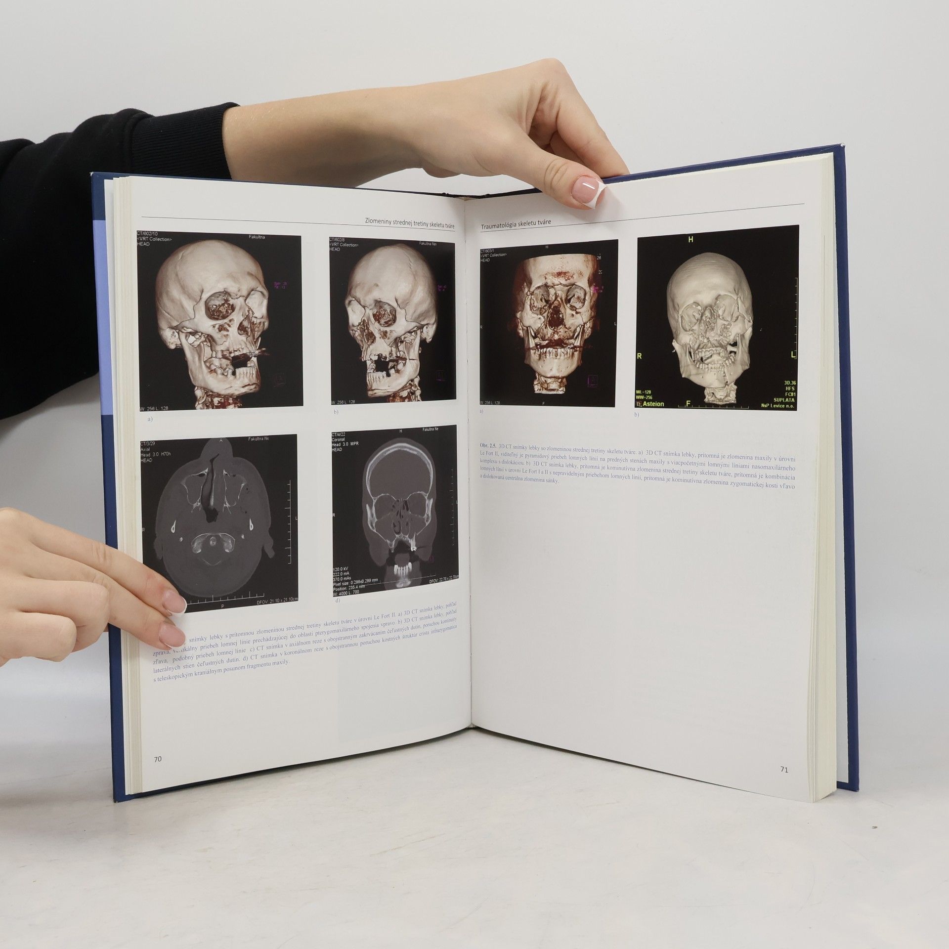 Dušan Hirjak Traumatológia skeletu tváre