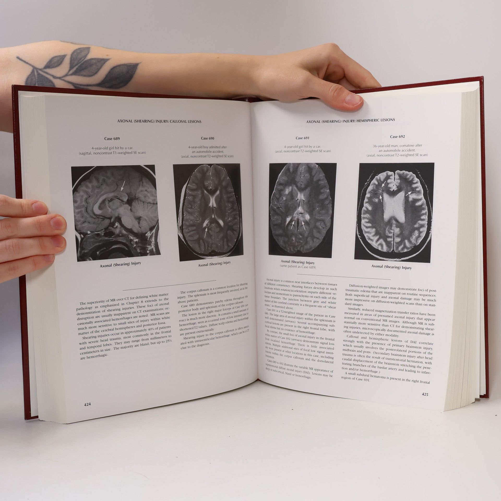 Douglas H. Yock Jr. Magnetic Resonance Imaging of CNS Disease