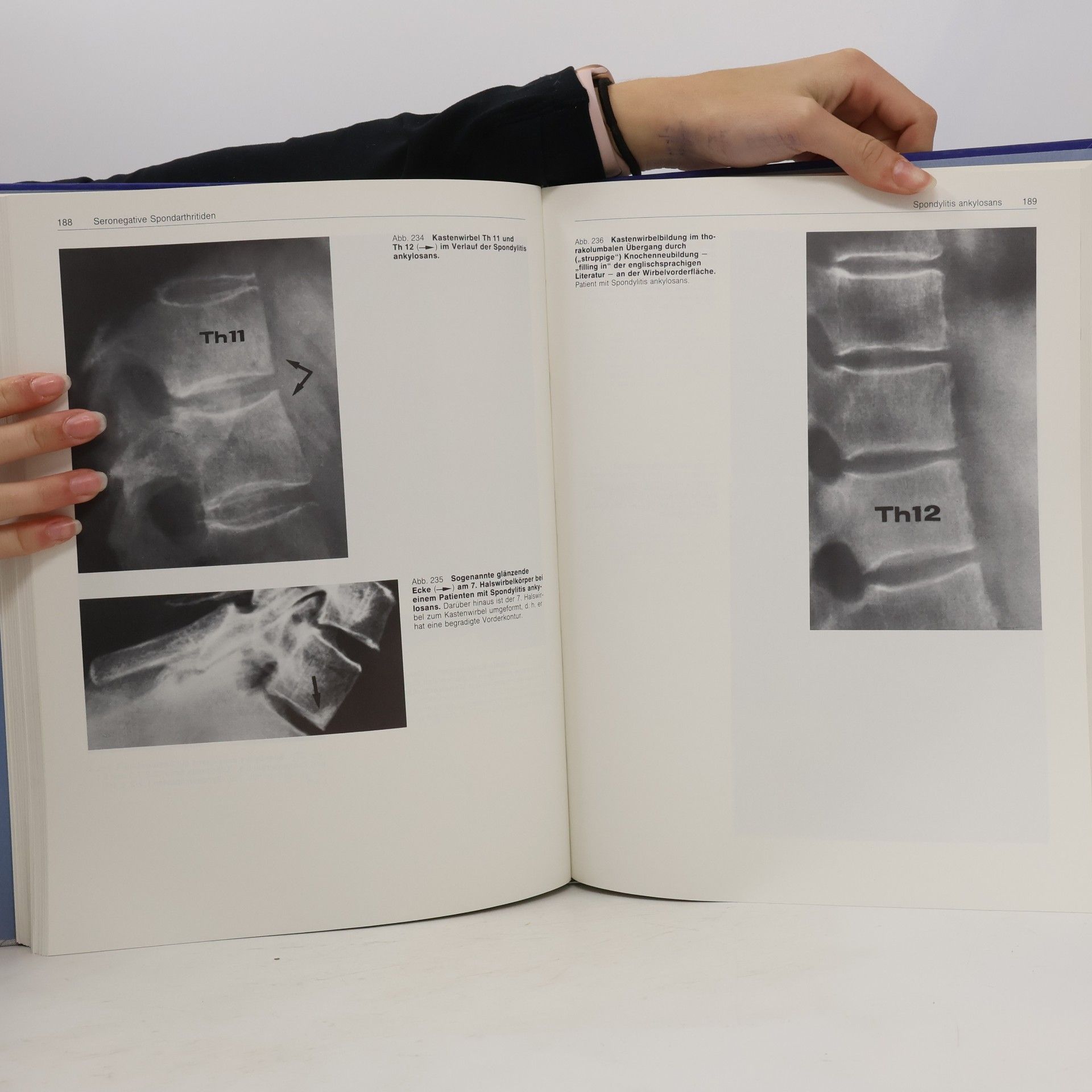 Wolfgang Dihlmann Röntgenatlas rheumatischer Krankheiten
