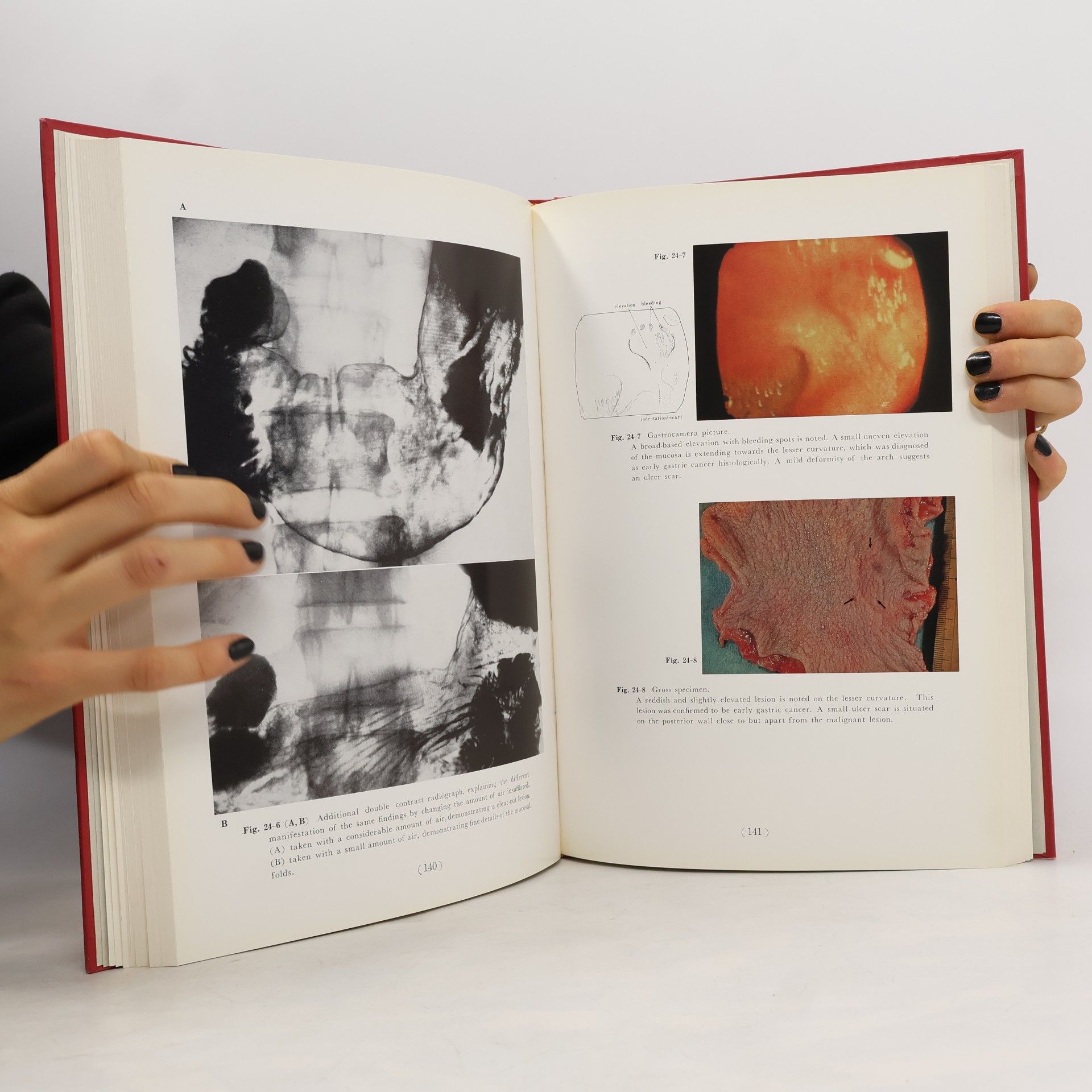 Kolektiv autorů Atlas of X-Ray Diagnosis of Early Gastric Cancer