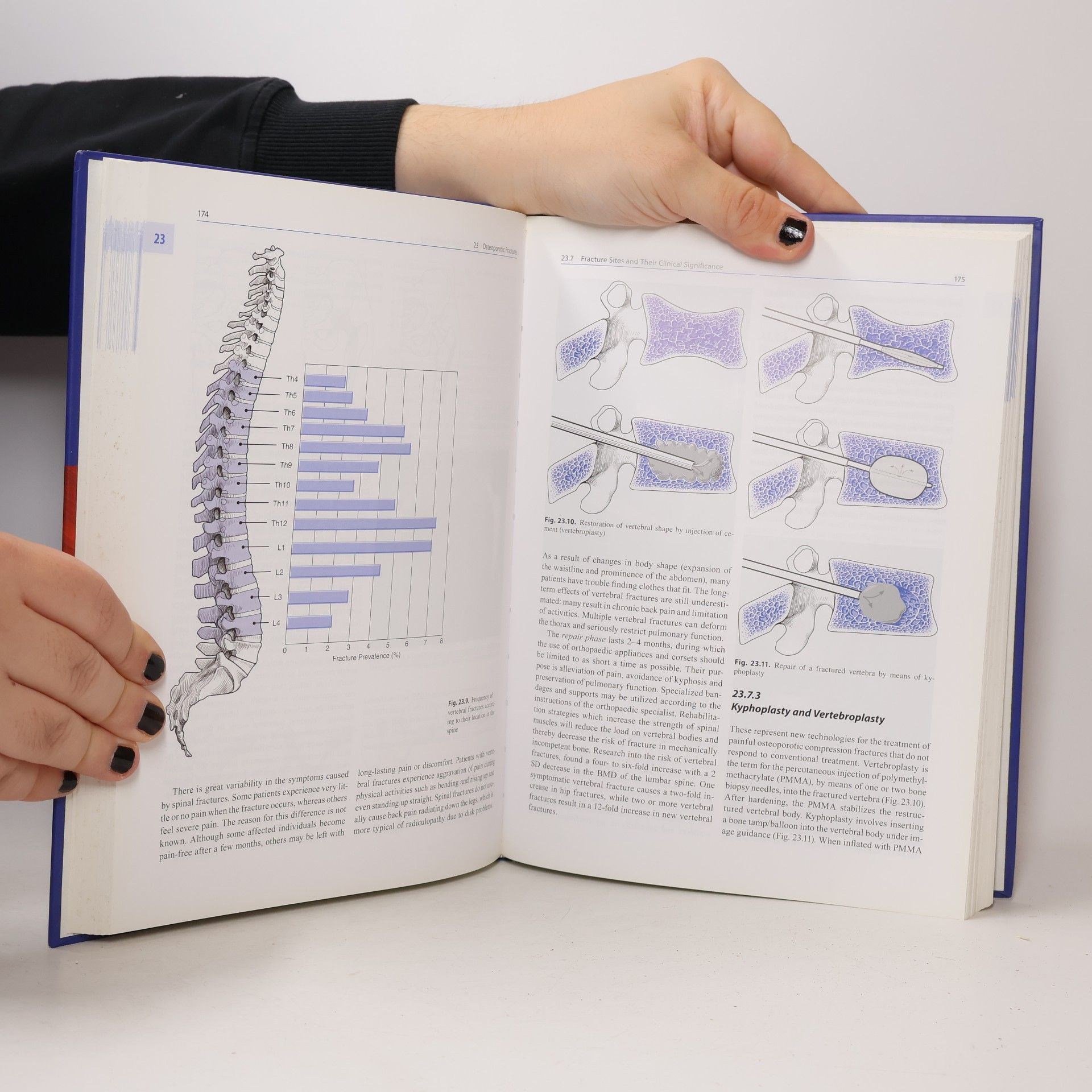 Reiner Bartl Osteoporosis : diagnosis, prevention, therapy