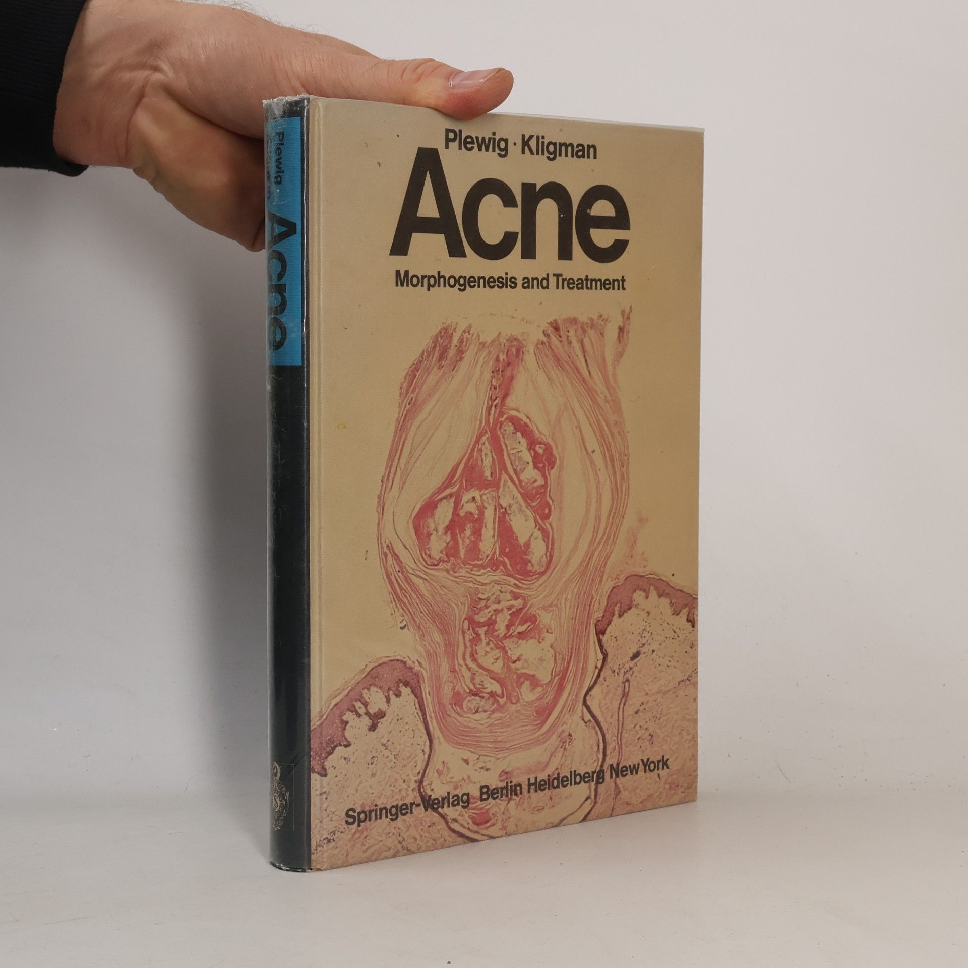 Acne
