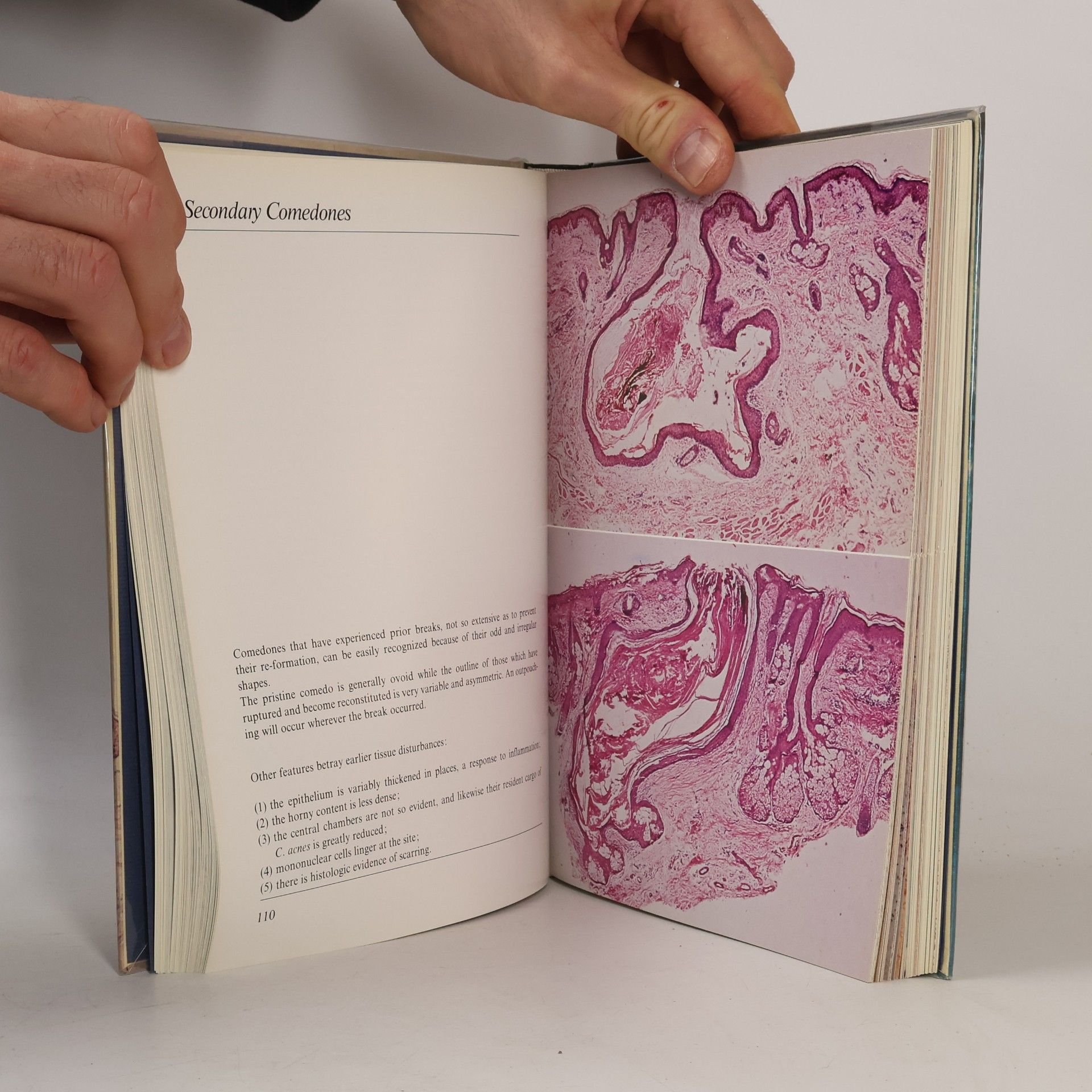 Gerd Plewig Acne