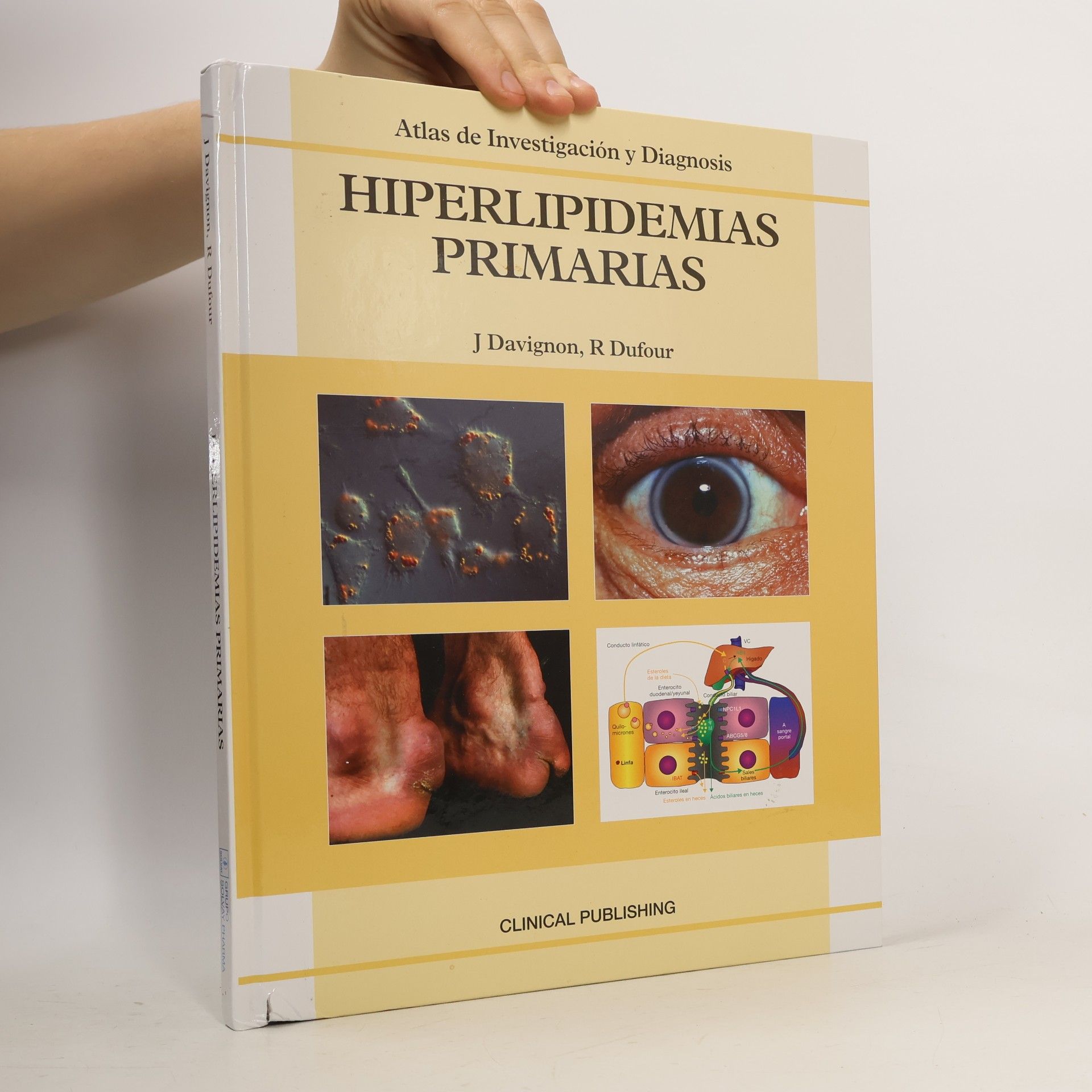 Primary Hyperlipidemias