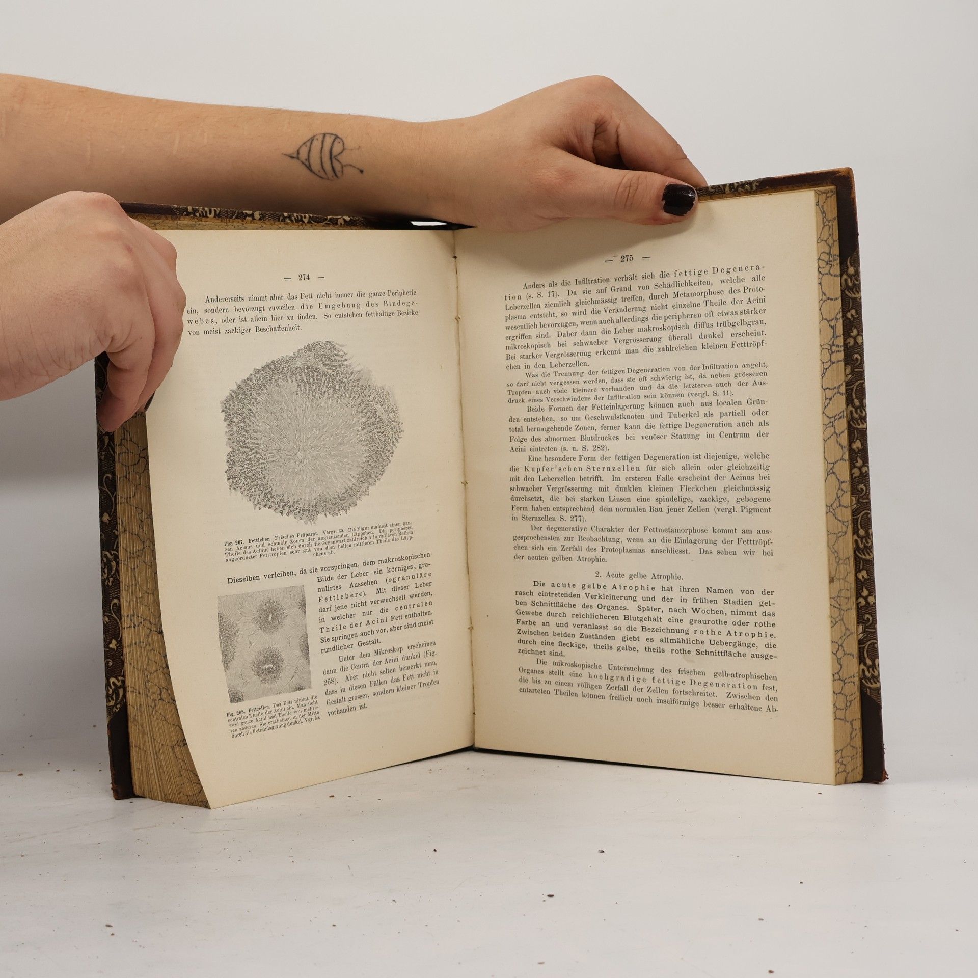 Hugo Ribbert Pathologischen Histologie
