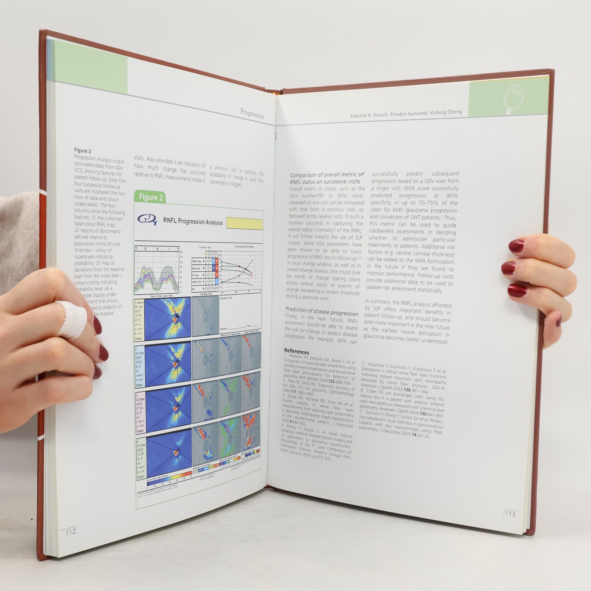 Michele Iester Optic Nerve Head and Retinal Nerve Fibre Analysis