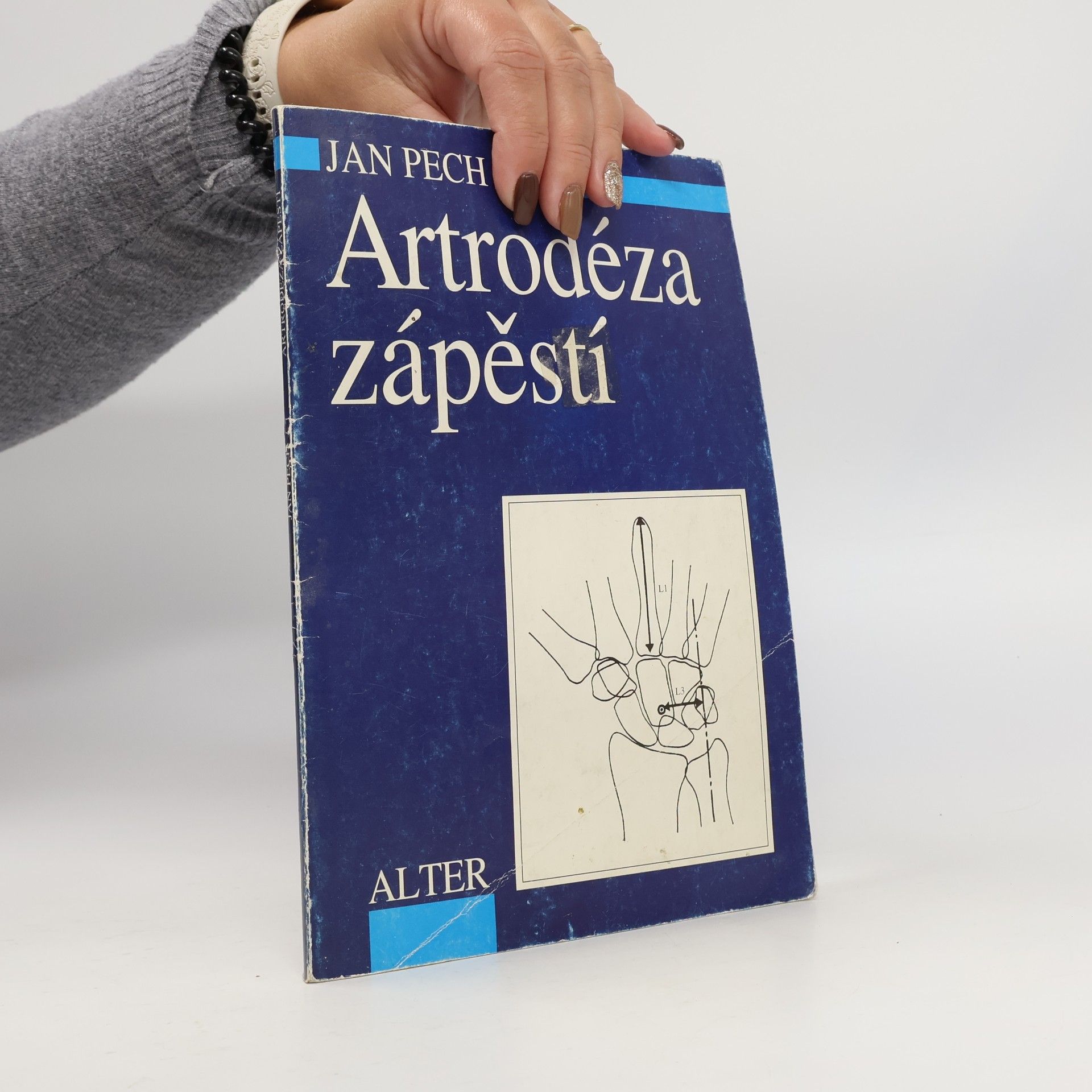 Artrodéza zápěstí