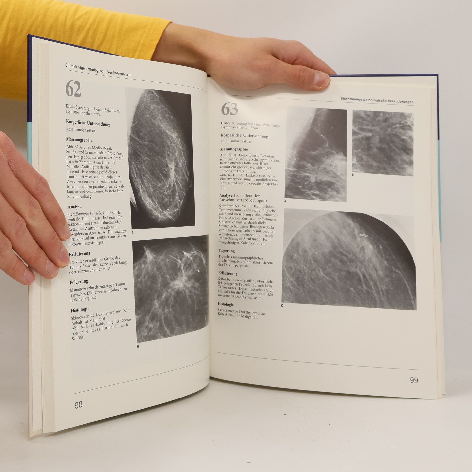 László Tabár Lehratlas der Mammographie. Sonderausgabe. deutsche Übersetzung von Ulrich R. Köppen