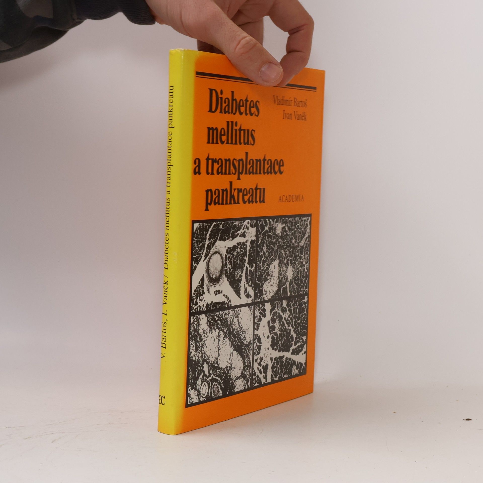 Diabetes mellitus a transplantace pankreatu