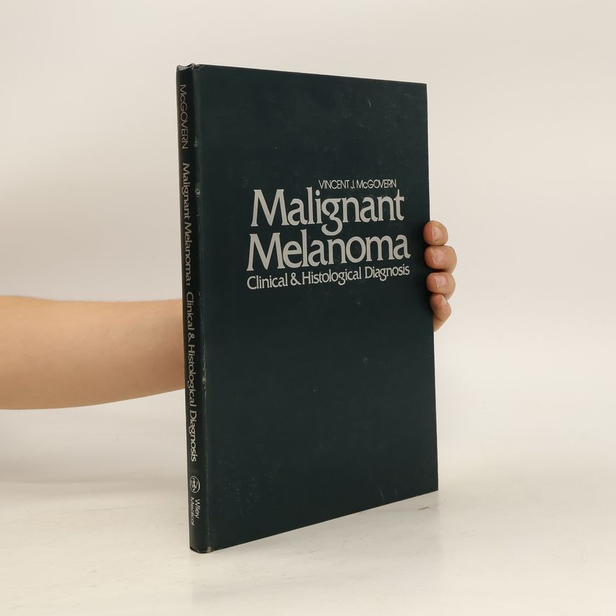 Vincent J. McGovern Malignant Melanoma