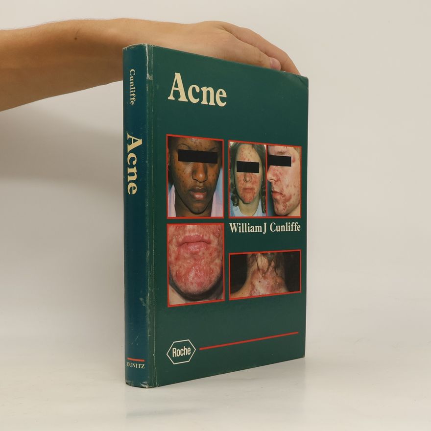 William James Cunliffe Acne